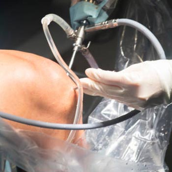 Arthroscopy in Vijayawada